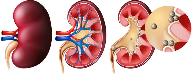 litíase renal, pedras nos rins