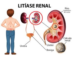 litiase nenal e pedras nos rins